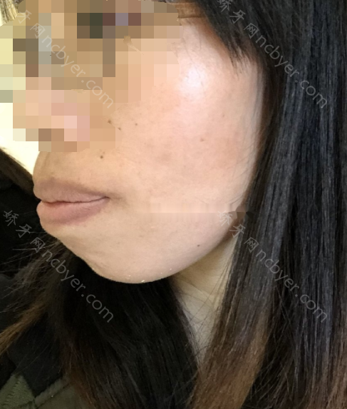 福州三栗鼠口腔门诊部郑嘉雄骨性嘴突矫正真人案例