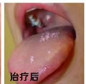 口腔白斑病怎么治疗？内含价格表及案例分析