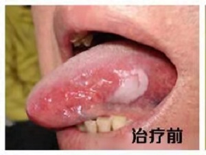 口腔白斑病怎么治疗？内含价格表及案例分析
