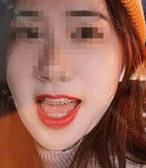 福州马泷口腔门诊部郑瑜谦骨性龅牙矫正真实案例