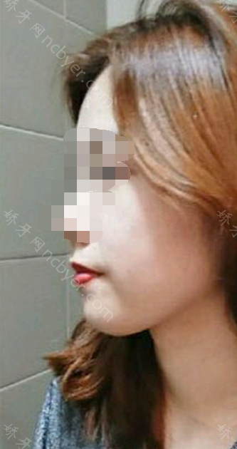 福州马泷口腔门诊部郑瑜谦骨性龅牙矫正真实案例