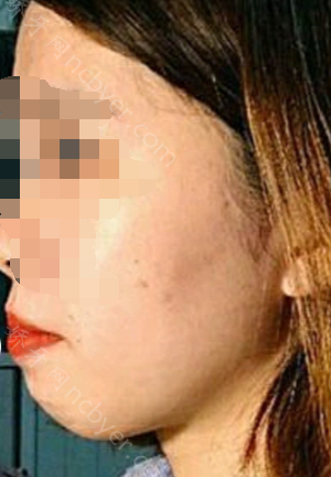 福州马泷口腔门诊部郑瑜谦骨性龅牙矫正真实案例