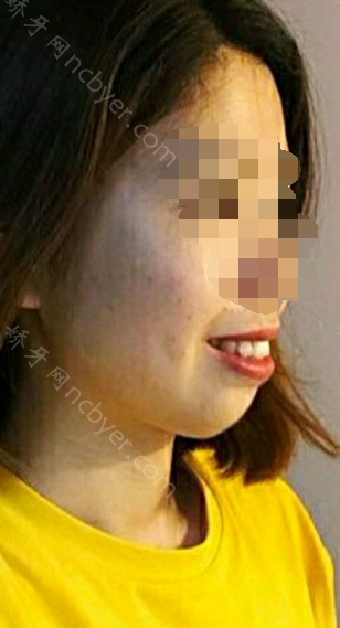 福州马泷口腔门诊部郑瑜谦骨性龅牙矫正真实案例