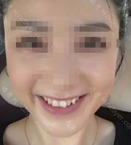 福州马泷口腔门诊部李晴牙齿矫正真实案例