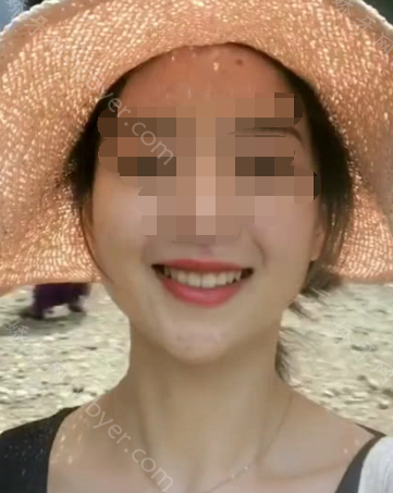 福州马泷口腔门诊部李晴牙齿矫正真实案例