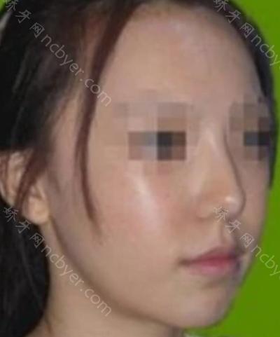 杭州市中医院口腔科杨国花医生做龅牙矫正的案例分享