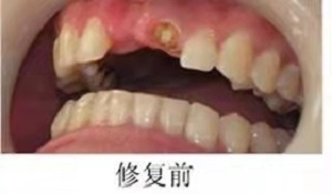 换一颗烤瓷牙好多钱？内含价格表及案例分析