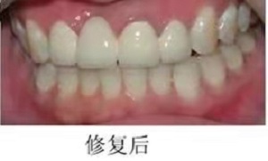 换一颗烤瓷牙好多钱？内含价格表及案例分析