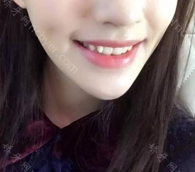 杭州兔牙医口腔医院王阳阳牙齿矫正案例大分享