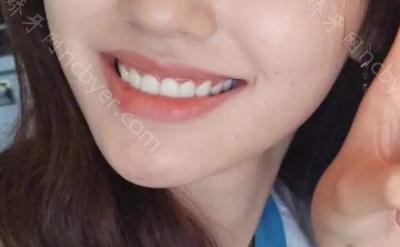 杭州兔牙医口腔医院王阳阳牙齿矫正案例大分享