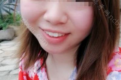 杭州兔牙医口腔医院王红丽牙齿矫正案例介绍