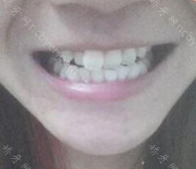 杭州口腔医院李小凤牙齿矫正案例分享