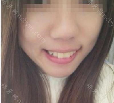 杭州口腔医院李小凤牙齿矫正案例介绍