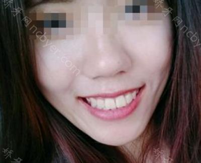 杭州口腔医院李小凤牙齿矫正案例介绍