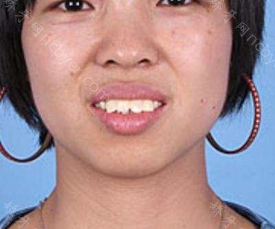 杭州口腔医院李小凤牙齿矫正真实案例分享