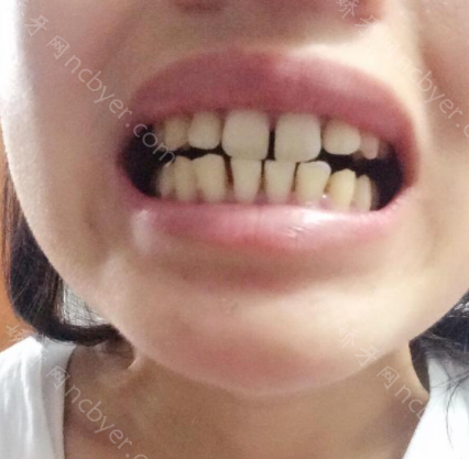 福州松鼠口腔门诊部卢婧牙齿矫正真实案例