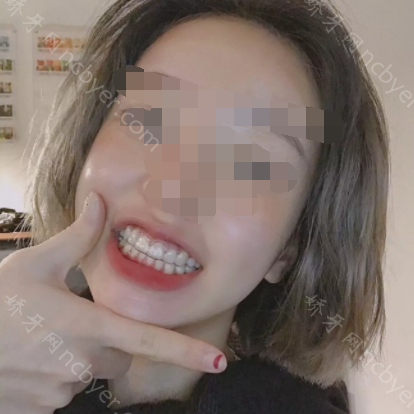 福州松鼠口腔门诊部卢婧牙齿矫正真实案例