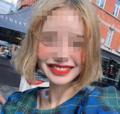 福州松鼠口腔门诊部卢婧牙齿矫正真实案例