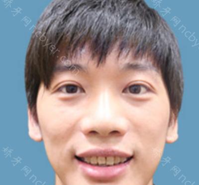 杭州艾维口腔医院陈俊牙齿美白案例分析