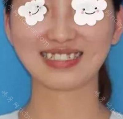 杭州拜博口腔医院高福敏牙齿矫正案例分享