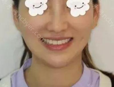 杭州拜博口腔医院高福敏牙齿矫正案例分享