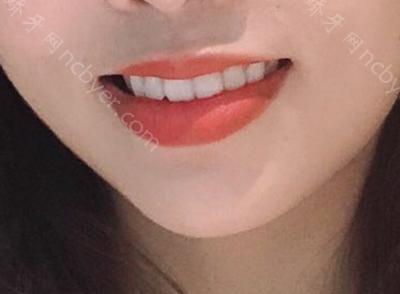 杭州拜博口腔医院高福敏牙齿矫正术前术后案例分享