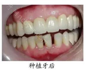 北京瑞泰口腔医院郭航做牙齿种植案例介绍