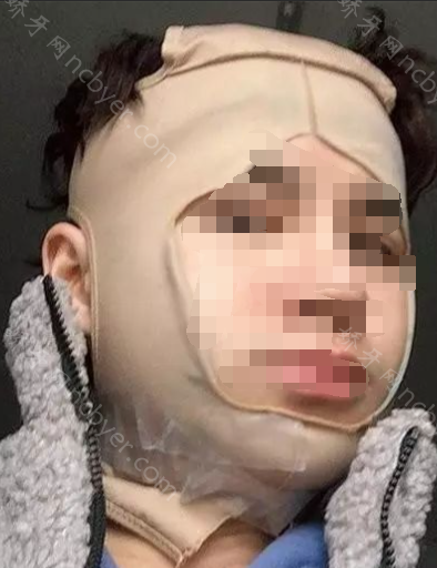 福州贝臣口腔门诊部李志杰地包天真实案例
