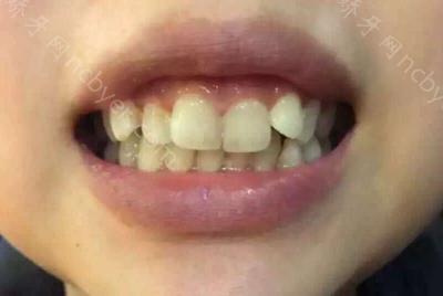 杭州拜博口腔医院高福敏做冷光美白案例分析