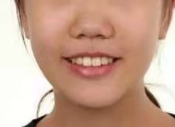 南通口腔医院拔牙价格？内含拔牙案例