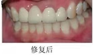 浙江省口腔医院城西分院怎么样？内含价格表及案例分析