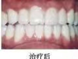 武大口腔医院拔智齿怎么样？内含最新1价格表及拔智齿真人案例分析
