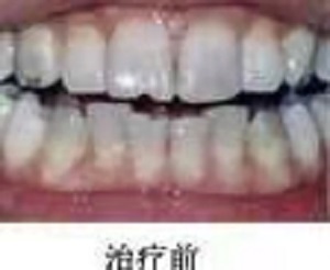 武大口腔医院拔智齿怎么样？内含最新1价格表及拔智齿真人案例分析
