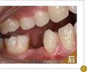 无锡口腔医院拔智齿多少钱？内含价格表及案例分析