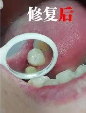 厦门口腔医院补牙收费标准？内含价格表及案例分析