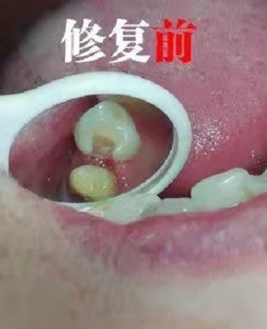 厦门口腔医院补牙收费标准？内含价格表及案例分析