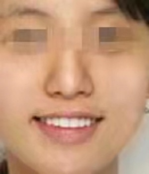 湛江牙齿矫正多少钱？内含价格表及案例分析