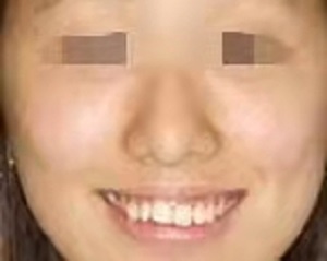 湛江牙齿矫正多少钱？内含价格表及案例分析