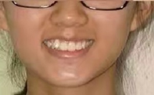 矫正一颗牙齿要多少钱？这篇文章告诉你牙齿纠正的价格