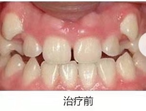 北京牙齿矫正多少钱？内含价格表及案例分析