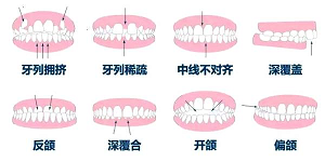 北京牙齿矫正多少钱？内含价格表及案例分析