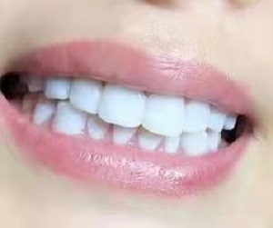 牙齿不齐越早矫正越好吗，牙齿不齐纠正前后对比