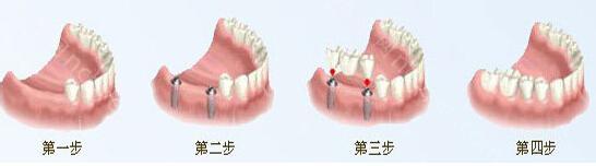 北京贝德尔口腔种植牙价格表上新;北京德贝尔口腔牙齿矫正怎么样？