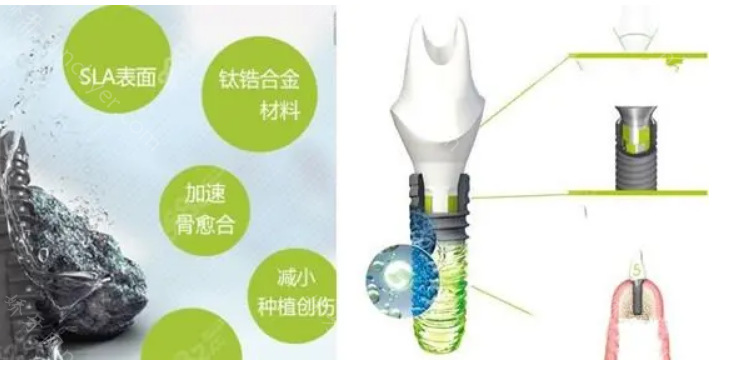 福州皓齿美齐口腔种植牙价格表出炉?国产华西2253元起/颗性价比高!