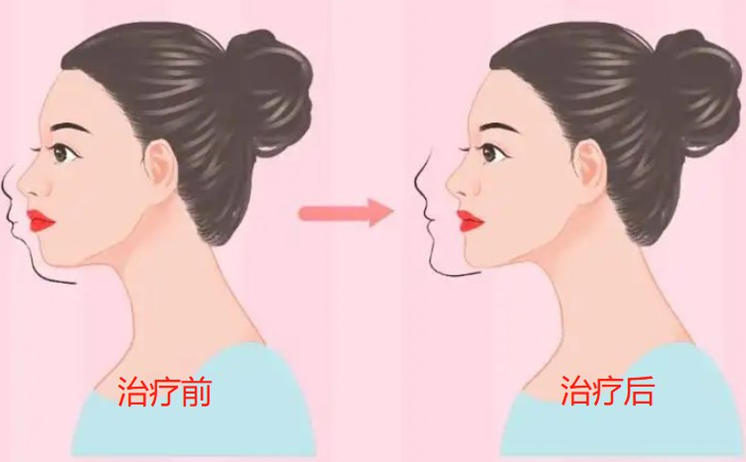 扩牙弓前后脸型会有变化吗？扩牙弓的相关知识你了解多少？