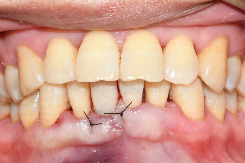 临时牙安装效果如何？临时牙可以长期使用吗？