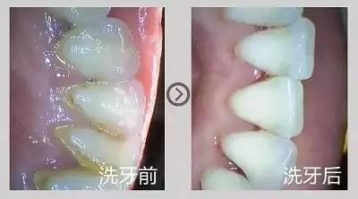 济宁牙齿清洁2024价格表:韩国DIO(迪奥)种植牙价格:1500元起/瑞典诺贝尔Active种植牙:4300元起