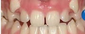 矫正牙齿完还要戴保持器？这篇文章告诉你答案