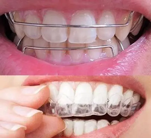 矫正牙齿完还要戴保持器？这篇文章告诉你答案