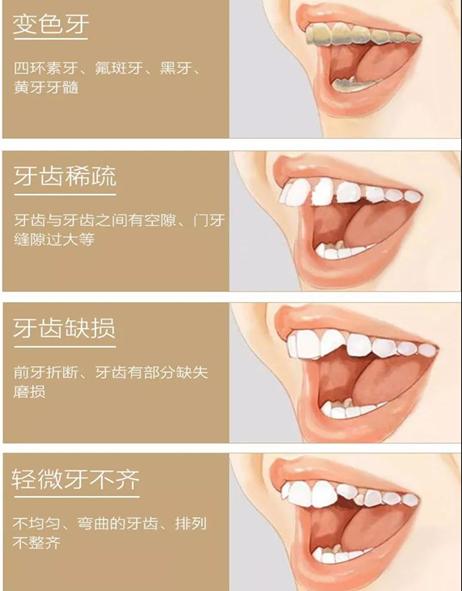 矫正牙齿贴面的危害_哪家医院做的比较好